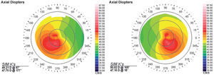 Corneal topographies for the two fellow eyes of a subject included in the keratoconus group. In this case, the disease was in the same stage in both eyes. For this subgroup of keratoconus eyes, the values of the slope of the cumulative percentage distribution plots were low, but higher than in the cases where the stage of the disease was different in each eye. For this particular example, the value of the slope was equal to 57.5.
