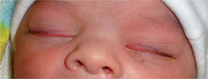 A 1-day old child with bilateral asymmetric congenital imbrication syndrome. The upper eyelids overlap the lower eyelids on eye closure. The eyelashes of the right lower eyelid are completely covered by the upper eyelid while the left upper eyelid is covering about 1 to 2 millimeters of the lower eyelashes.