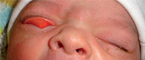 Spontaneous eversion of the right upper eyelid while yawing. The tarsal conjunctiva of the everted eyelid is hyperemic.