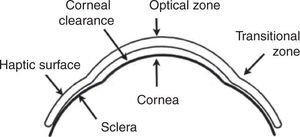 Fitting relationship of the scleral contact lens.