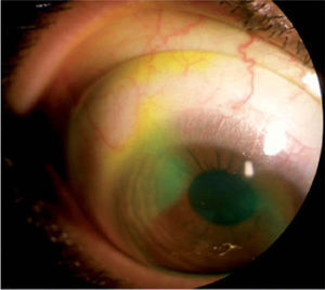 Fluorescein dye diffusion under the GP-SCL haptic into pre-corneal fluid reservoir.