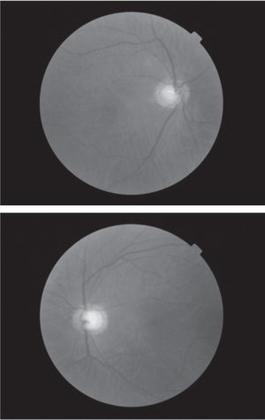 Optic nerve photographs depicting enlarged cup-to-disk ratios.