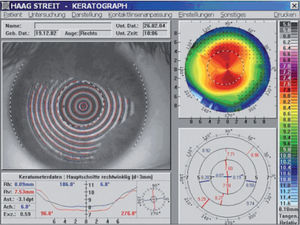 Baseline topography showing with-the-rule astigmatism of 3.10D.