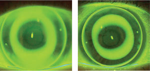 Traditional orthokeratology vs FOKX design.