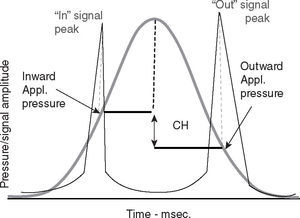 ORA Signal from a normal subject’s eye corneal hysteresis (CH).