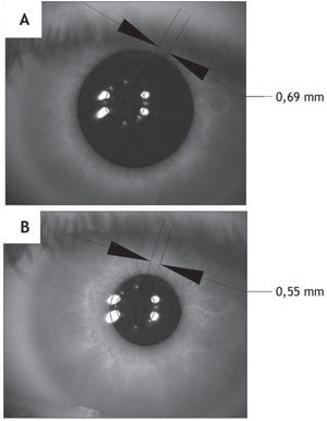 Images of the pupil center for low (a) and high (b) lighting conditions. Pupil decentering values are included for both conditions for comparison.