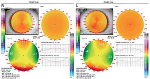 Pre-treatment topographical elevation maps of the right (R) and left (L) eyes. Those elevation maps reveals: OD: a difference of 61.5μm between meridians, OS: a difference of 65.5μm between meridians. According to general guidelines these differences justify the use of Dual Axis lens.