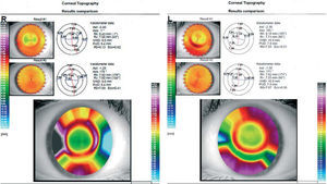 Comparison of corneal topography after one night wearing Dual Axis (Result#1) to pre-CRT topographies (Result#2). In pre-CRT topographies slight WTR astigmatism can be seen in both eyes.