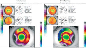 Comparison of corneal topography after two weeks wearing the lenses (Result#1) to pre-CRT topographies (Result#2).