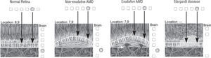 Scheme of a normal Retina vs photoreceptor rising due to AMD vs photoreceptor absence in Stargardt
