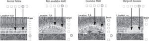 Scheme of a normal Retina vs photoreceptor rising due to AMD vs photoreceptor absence in Stargardt's disease.