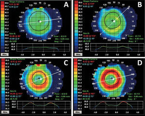 Tangential topographic maps of curvature measured over the front surface of contact lenses placed on a nearly spherical cornea. Lenses had add powers of +1.00 D (A), +2.00 D (B), +3.00 D (C) and +4.00 D (D). Obtained with Medmont E300 corneal topographer (Medmont, Australia). Values in diopters.