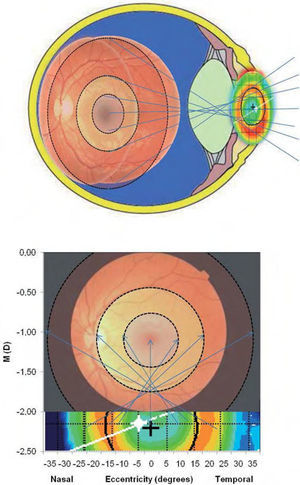 Graphical representation of the areas in the retina affected by the change in refraction induced by the multifocal contact lens. The draw assumes an asymmetrical distribution of myopic effect arround the fovea in every direction althouth present study only analyzes the horizontal meridian.