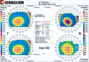 Orbscan™ II topographic map of centred cone. Note cone apex located within the central 2mm zone.