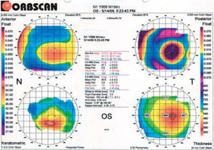 Orbscan™ II topographic map of oval cone. Note cone apex located outside the central 2mm zone.