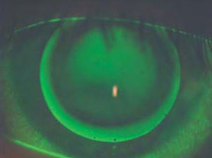 Example of fluorescein pattern of 8.7mm KCGP-1 lens on centred cone.