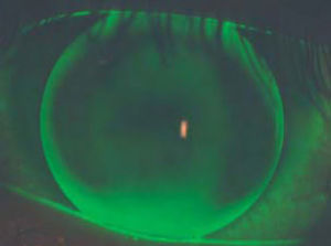 Example of fluorescein pattern of same participant wearing 9.6mm KCGP-1 lens.