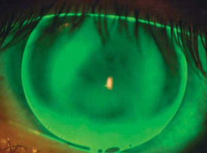 Example of fluorescein pattern of same participant wearing 10.4mm KCGP-1 lens.