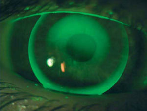 Example of fluorescein pattern of 9mm KCGP-2 lens on oval cone.