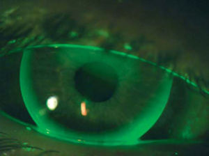 Example of fluorescein pattern of same participant wearing 9.6mm KCGP-2 lens.