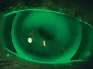 Example of fluorescein pattern of same participant wearing 10.1mm KCGP-2 lens.