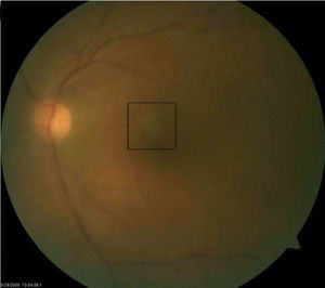 Placoid yellow retinal lesion in the superior para-foveal region and vitritis OS.