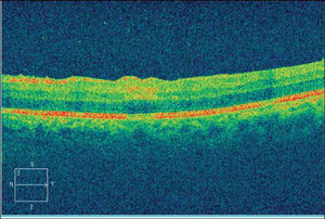 Pre-treatment spectral domain OCT demonstrating hyper-reflectivity involving the inner plexiform/ganglion cell layer corresponding to the para-foveal lesion OS. There is also optical shadowing of the underlying retinal pigment epithelium (RPE). Outer retinal layers and photoreceptors are spared.