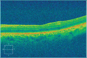 Post-treatment spectral domain OCT demonstrating resolved retinitis as evidenced by the decreased thickness of the inner retinal segments. Outer retinal layers are spared.