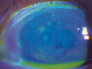 Microdendrites on patient's right cornea that stain with flourescein.