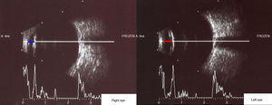 B-scan showed shallower anterior chamber depth of his right eye (blue line) than his left eye (red line).