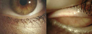 The lower lid and upper of the right eye observed before treatment.