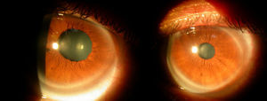 Images from dynamic pupillometry when pupil diameters were examined under photopic conditions (right: left eye; left: right eye). Significant difference between eyes could be observed.