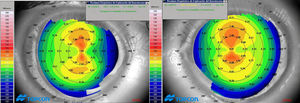 Corneal topography of both eyes obtained with the Topcon CA-100 FLUO system (right: left eye; left: right eye). Only axial map is displayed. A similar bow-tie configuration was found in both eyes.