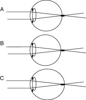 Three variants of the position of the depth of focus in the emmetropic eye: middle (A), posterior (B) and anterior (C).