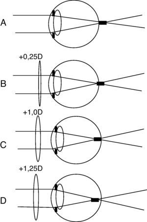 Displacement of the depth of focus in the emmetropic eye in the course of subjective method of refractometry.