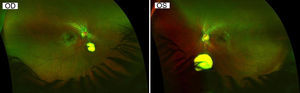 Optomap image of OD (left) and OS (right), each showing the atrophic area and white sclera of the coloboma with an absence of the green colored retinal pigment epithelium.