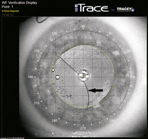 Image of the right eye of the patient captured with the iTrace. The IOL position is viewed with respect to the pupil center (green cross) and the corneal vertex (red cross). Black arrow shows the edge of IOL.