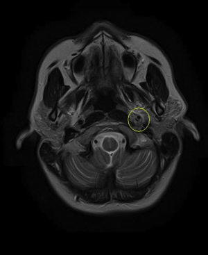 First MRI of acute left internal carotid artery dissection.
