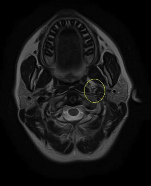 Second MRI of acute left internal carotid artery dissection.