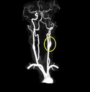 MRA of the acute left carotid artery dissection.