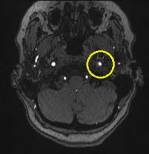 Repeat MRI 2–3 months later of left carotid artery dissection with vast improvement in lumenal patency/diameter.