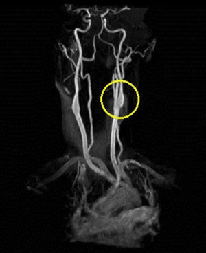 Repeat MRA 2–3 months later of left carotid artery dissection with vast improvement of lumenal patency.