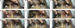Nine diagnostic action fields of gaze demonstrating restricted EOMs of the left eye.