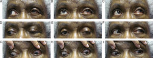 Nine diagnostic action fields of gaze demonstrating improvement in EOMS of the left eye.