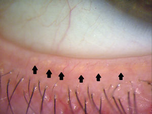 Slit lamp image of the lower lid margin showing the meibomian orifices.