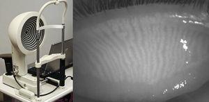 The OCULUS Keratograph 4 functions primarily as a corneal topographer, however the infrared diode intended for pupillometry can be used as an infrared illumination source for meibography (left). An everted superior eyelid reveals long thin MGs running vertically on the palpebral side as visualized by the OCULUS Keratograph 4 in infrared light (right).