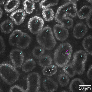 A 400μm×400μm frame of acini clusters as seen with the HRT-II Rostock Cornea Module. Acini units (cyan) and inflammatory cells (magenta) are manually marked, and density for each is automatically calculated using the Cell Count® software (Heidelberg Engineering GmbH, Germany).