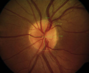 Visupac digital measurement program and optic disc Image 20°. Optic disc area and diameter measurement: measurement icon (black arrow), lineal measurement icon (diameter) and polygonal outline (area) (white arrows) – results are in mm and mm2.
