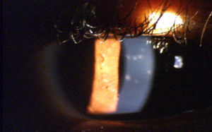 Subepithelial infiltrates associated with EKC.