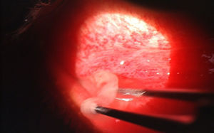 Removal of pseudomembrane secondary to EKC.